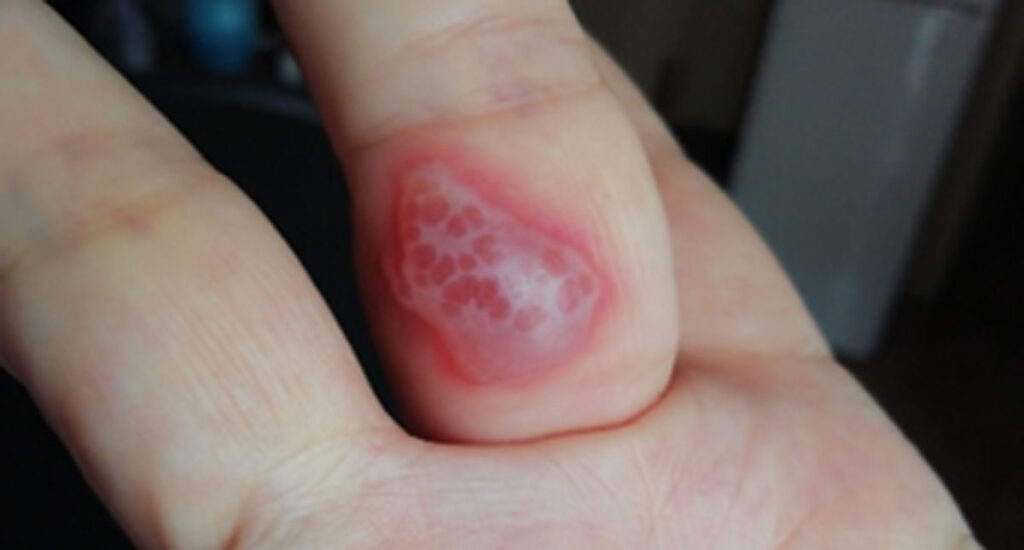 Blister-Allergic Reactions to Sanitisers and Disinfectants