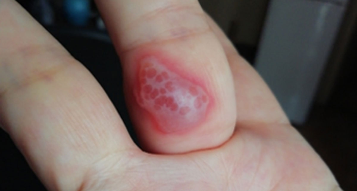Blister-Allergic Reactions to Sanitisers and Disinfectants